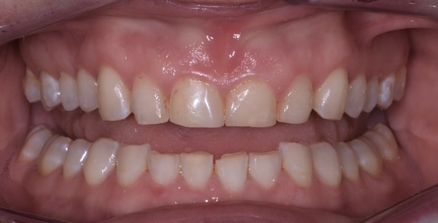 All-Ceramic — Before